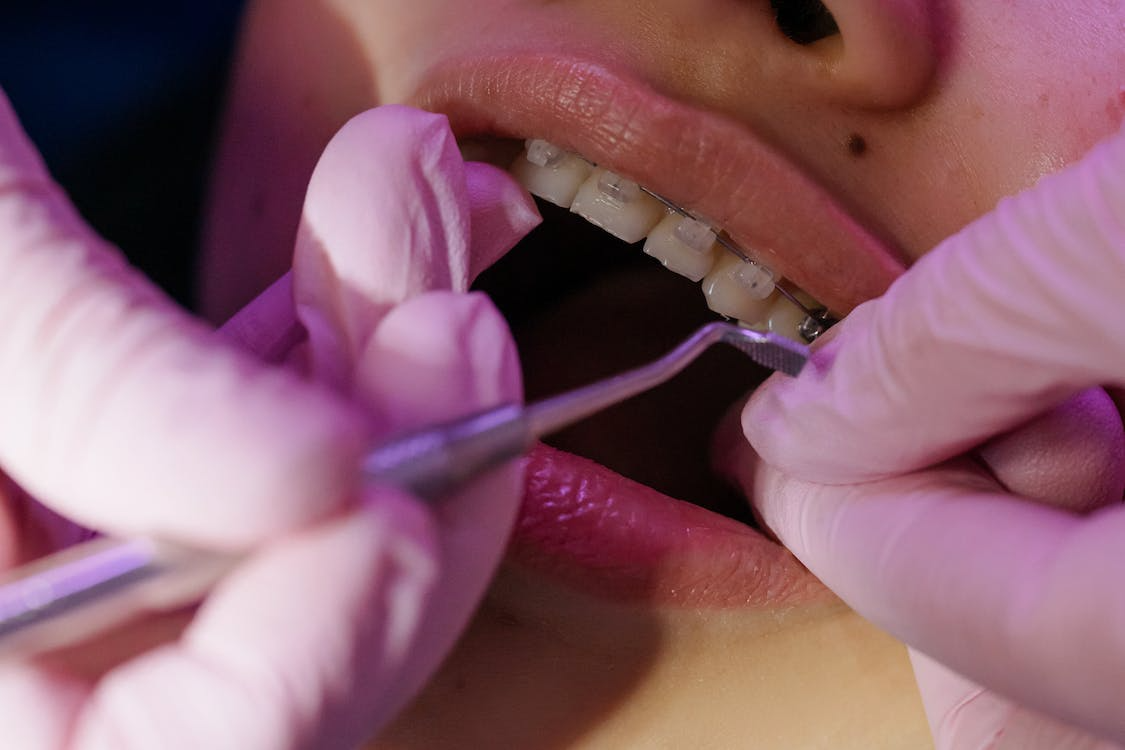 Ways to Get Whiter Teeth